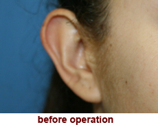 plastic-surgery-prominent-ear 